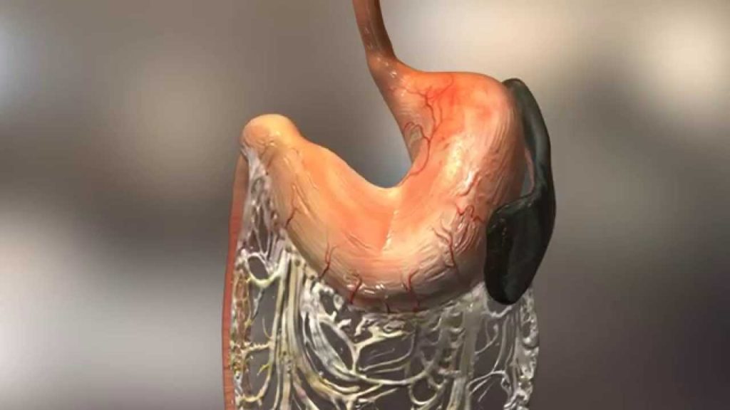 gastric dilatation volvulus image